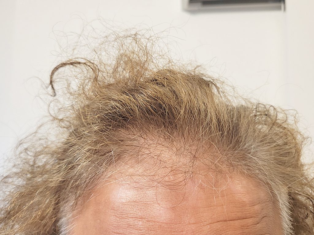 リグロ大作戦 リグロ ロート製薬 一ヶ月後の成果は? 額の写真