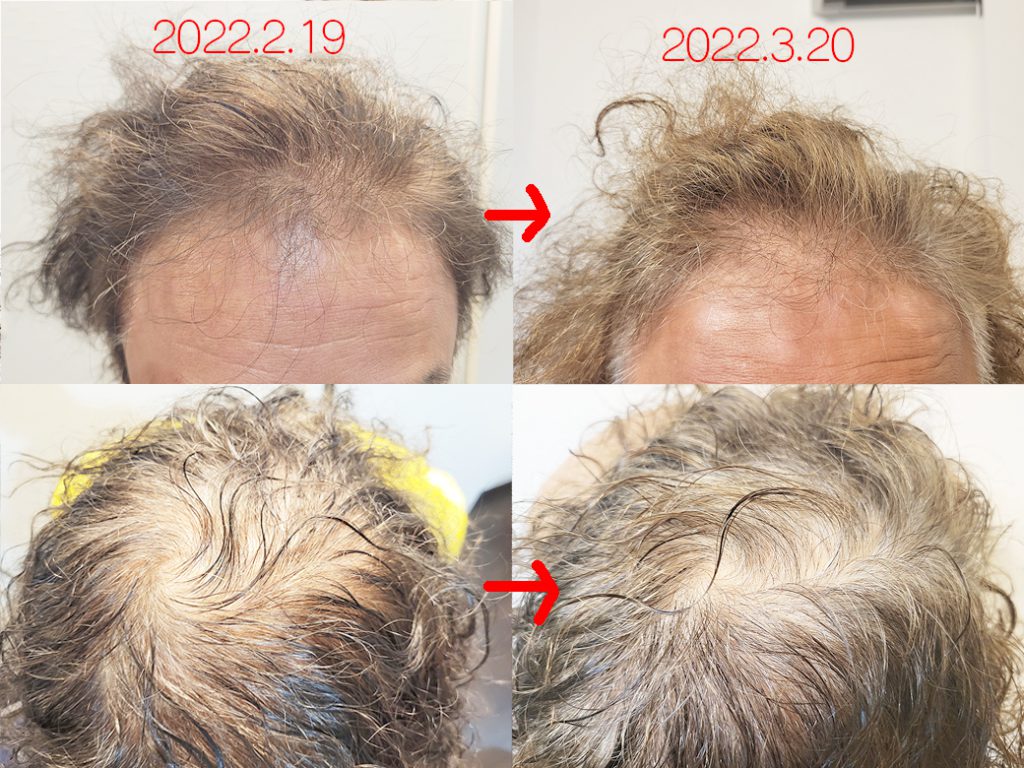 リグロ大作戦 リグロ ロート製薬 一ヶ月後の成果は? 一ヶ月後の比較
写真