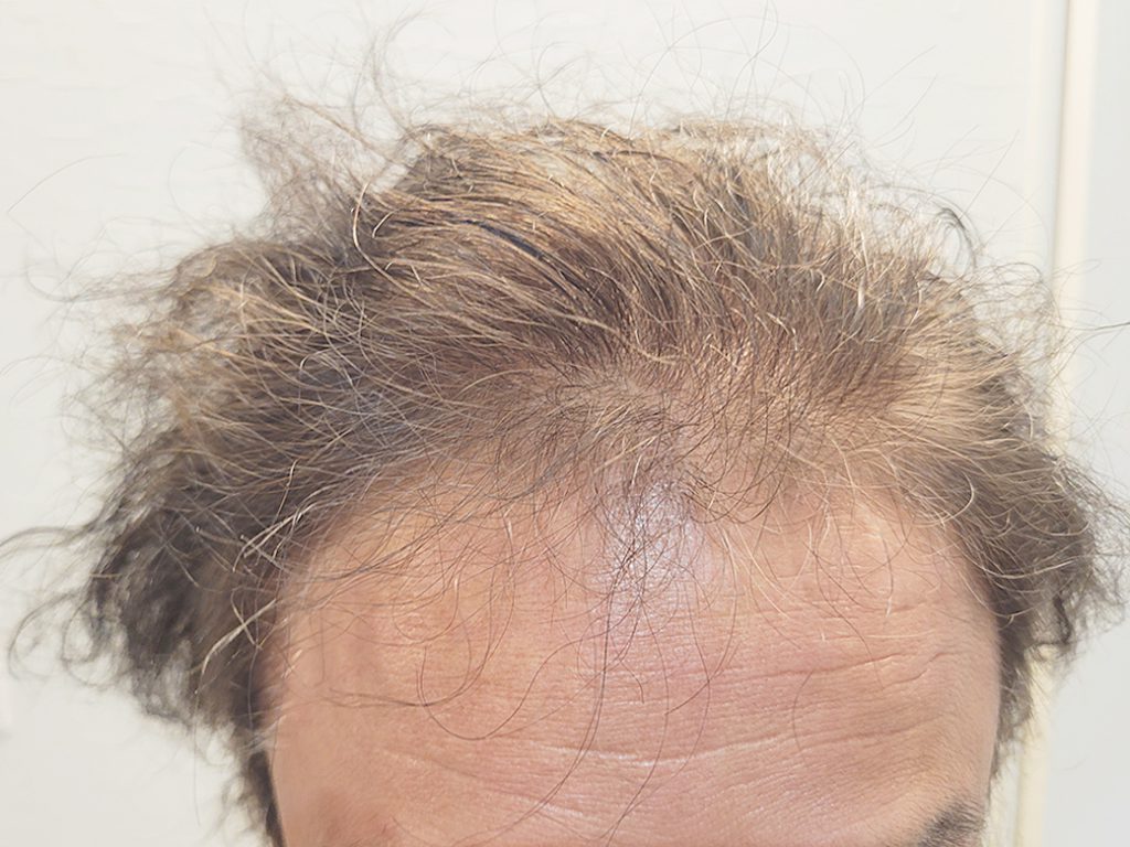 リグロ大作戦 リグロ ロート製薬 現状写真 額部