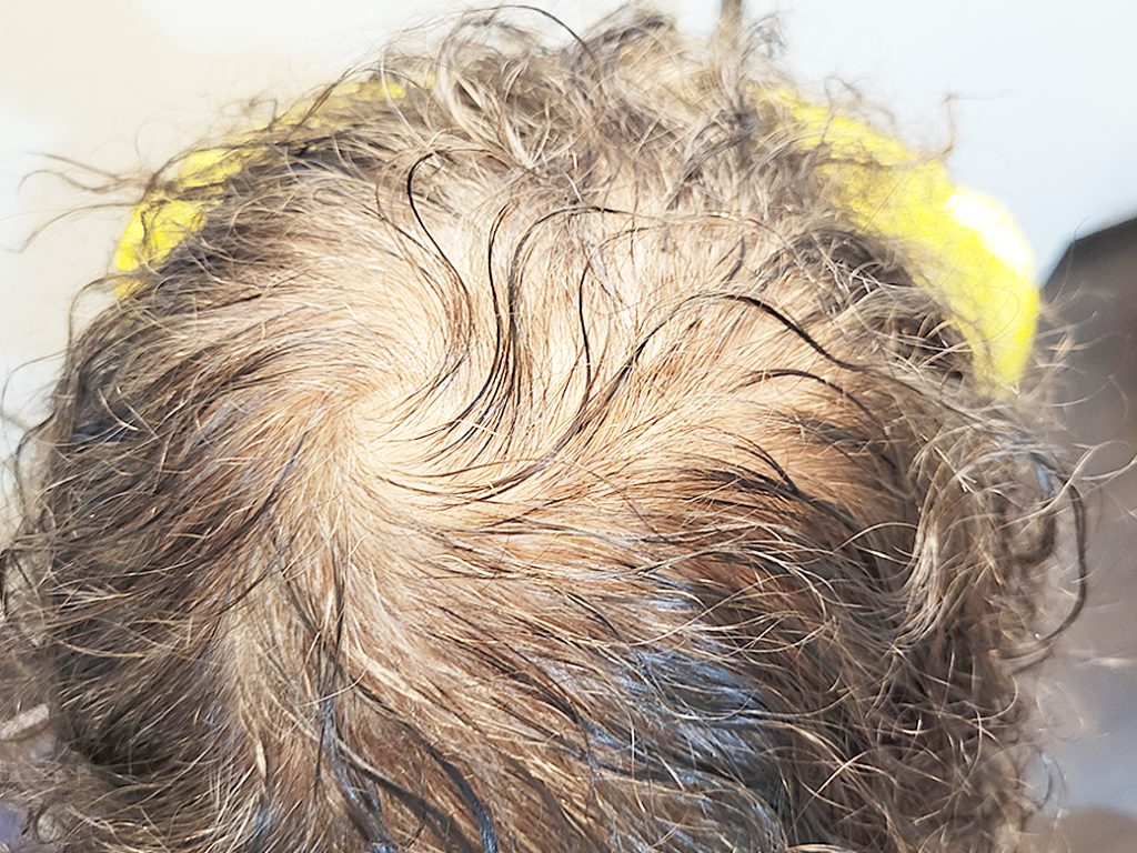 リグロ大作戦 リグロ ロート製薬 現状写真 頭上部