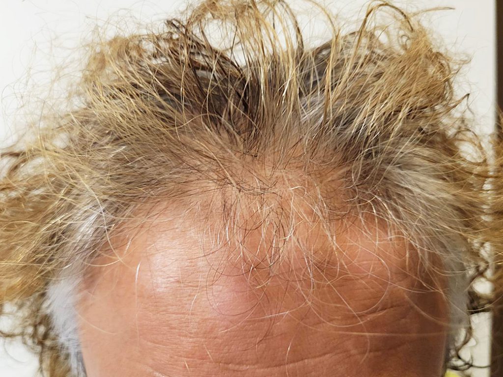 リグロ大作戦 リグロ ロート製薬 二ヶ月後の成果は? 額の写真