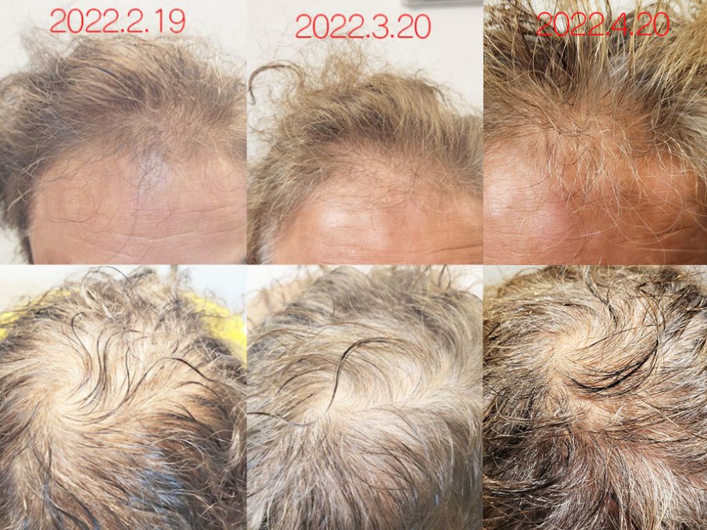 リグロ大作戦 リグロ ロート製薬 二ヶ月後の成果は? 比較写真