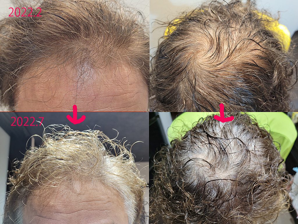 リグロ大作戦!第二章に突入w!!4ヶ月目のご報告 使い始めとの比較写真